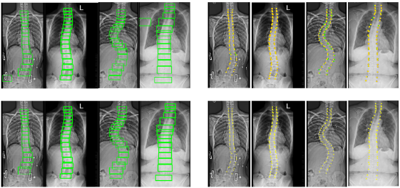 Automatic Spine Curvature Estimation from X-ray Images