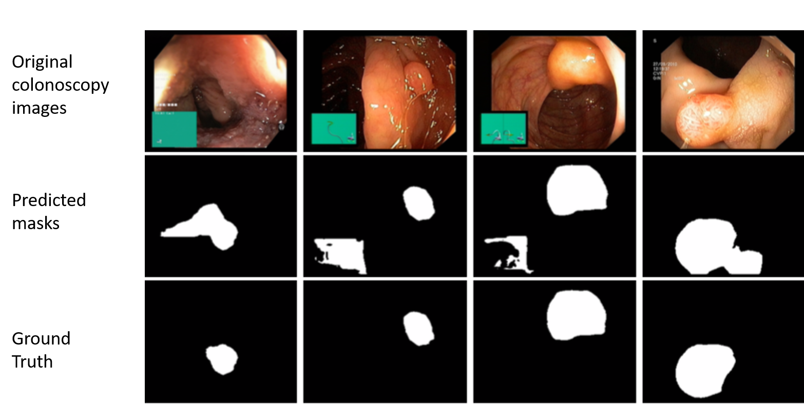 GI tract anomaly detection from endoscopy images